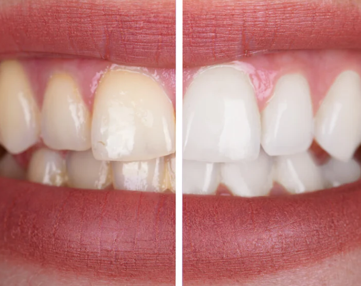 SmileKit V34 Tandbleknings färgkorrigering 30ml